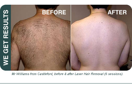 picture of before and after laser hair removal